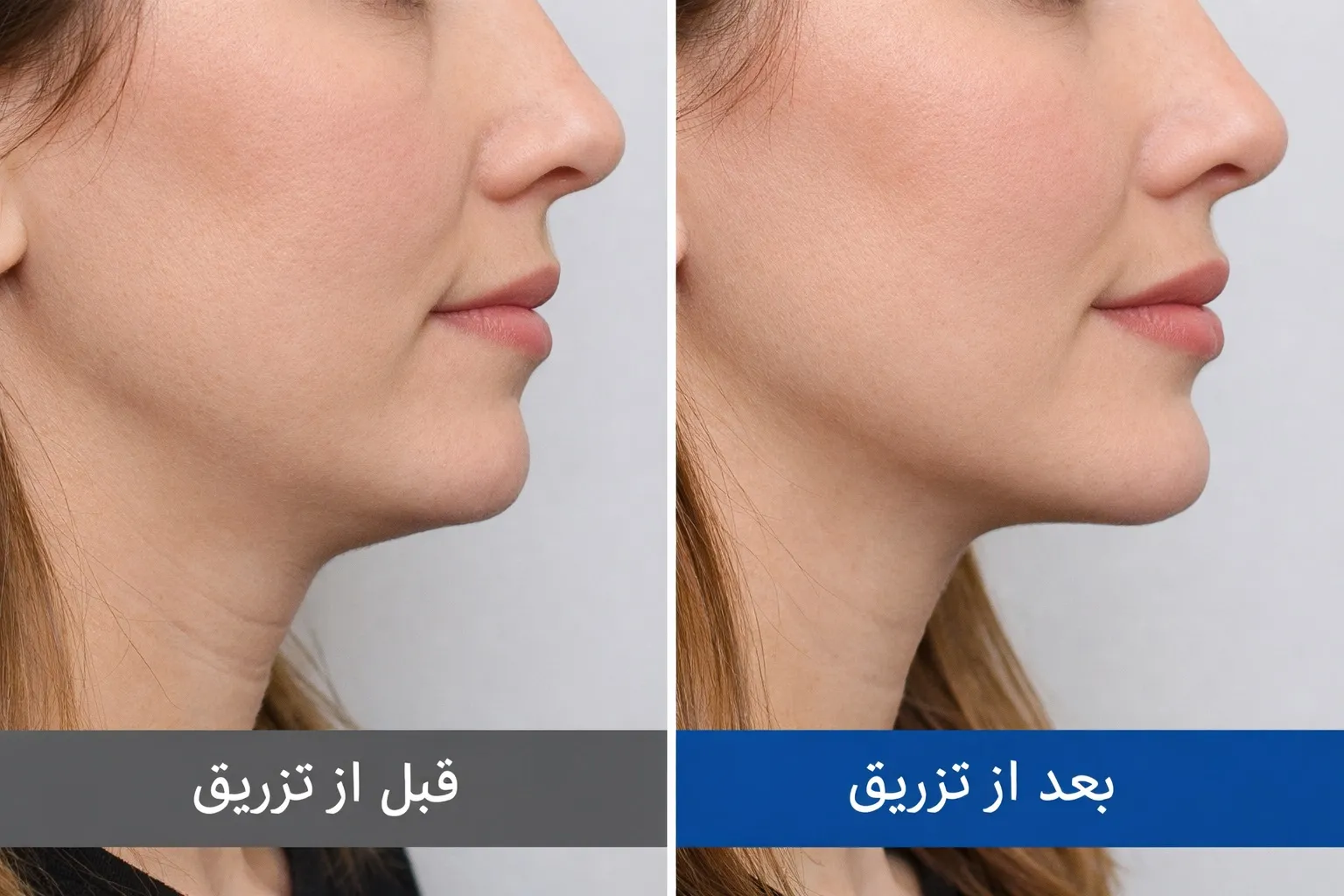 آنچه باید درباره ژل چانه، کاربرد و عوارض آن بدانید